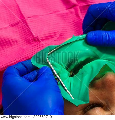Installation Of A Cofferdam To The Patient, Modern Dental Equipment, Treatment In Sterile Conditions