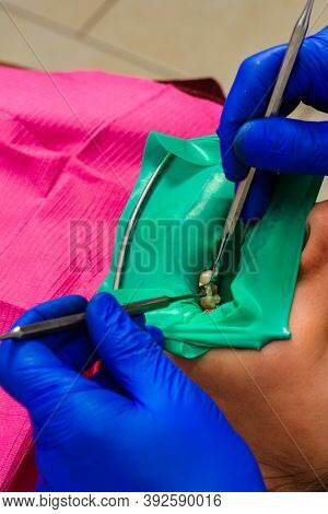 Dentist Treats The Tooth With Modern Methods, Uses A Rubber Dam, Sterile Tooth Treatment.