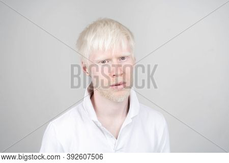 Albinism Albino Man In Studio Dressed T-shirt Isolated On A White Background. Abnormal Deviations. U