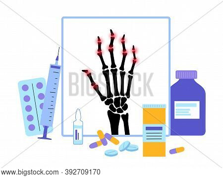 Pain And Inflammation In Hand On X Ray. Rheumatoid Arthritis Symptom On Human Joints And Bones. Doct