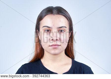 Young Woman Brunette Portrait, Prevention Of Oily Skin And Acne