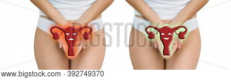 Woman Showing Healthy And Uterus With Disease. Treatment Uterus, Female Health, Gynecology