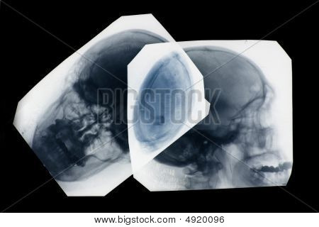 Röntgen bilder av människans kranium