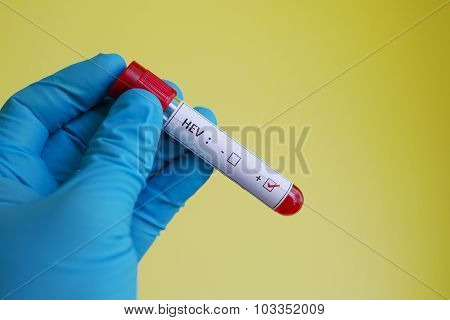Hepatitis E virus (HEV)