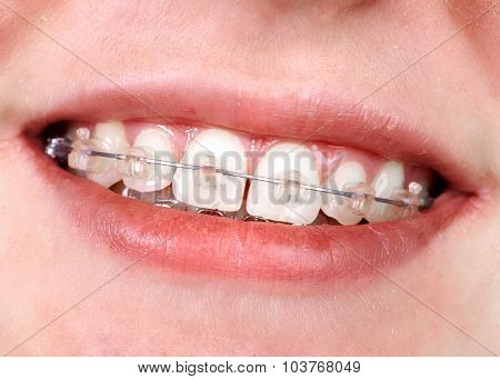 Teeth with orthodontic brackets. Dental health care.