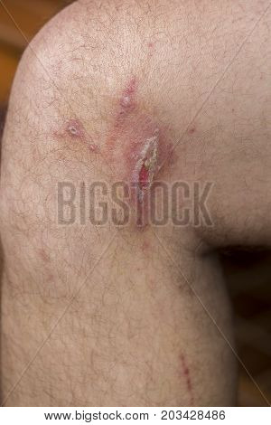 Irritant contact dermatitis at man leg close up.. Pederus-dermatitis - Allergic reaction to the blood type of beetles Paederus characterized by vesicular dermatitis