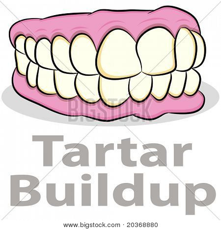 Uma imagem de um acúmulo de tártaro nos dentes.