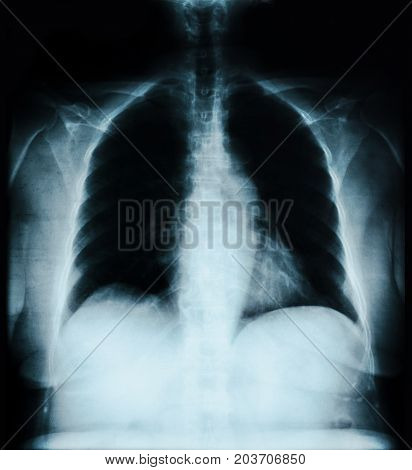 The X ray lung image on black.