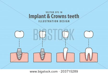 Implant & Crowns Teeth Illustration Vector On Blue Background. Dental Concept.