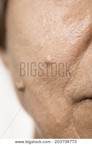 Details of senior woman face. Elderly pensioner female dermal fibroma close up.