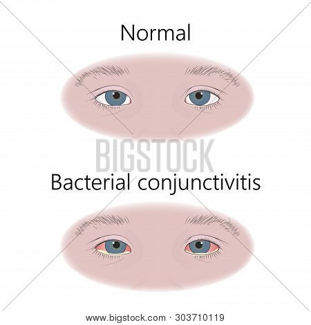 Bacterial Conjunctivitis. Infection. Comparison With Normal. Flat Medical Illustration.