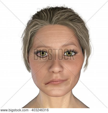 Facial Nerve Paralysis, Bells Palsy, 3d Illustration Showing Female With One-sided Facial Nerve Para