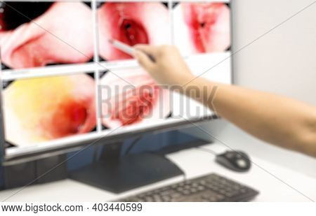 Blurred Image Medical Image Gastrointestinal Endoscopic Examination Image Showing Acute On Chronic G