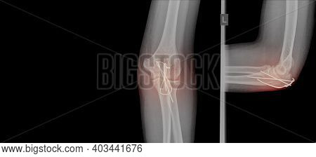 X-ray Elbow Showing Fracture (proximal Ulna Or Olecranon Fracture) Treated By Surgery With Tension B