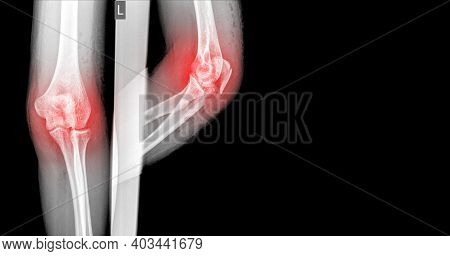 X-ray Elbow Showing Fracture (proximal Ulna Or Olecranon Fracture) Highlight.medical Healthcare Conc