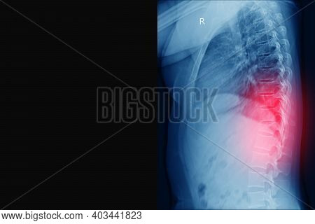 X-ray Thoracic Spine Fracture Radiograph Of Thoracic And Lumbar Spine Lateral Projection, Traumatolo