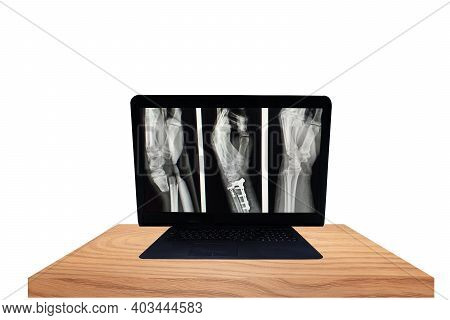 X-ray Left Wrist Fracture Distal Metaphysis Of Both Bones Forearm.dorsol Displacement Of Distal Frag