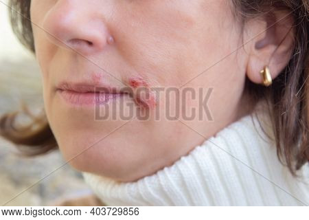 Treatment Of Herpes Infection And Virus With Ointment. Herpes On The Lips, Part Of A Woman's Face Wi