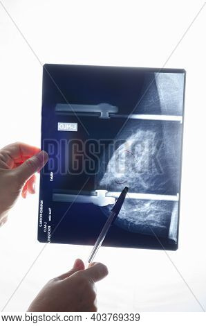 X-ray Mammogram Image With Mediolateral Oblique (mlo) View Of The Left Female Breast With Cysts