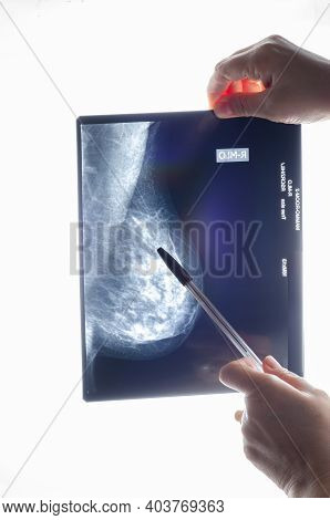 Mediolateral Oblique (mlo) View Of The Right Female Breast With Cysts