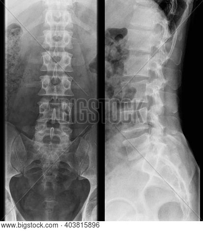 X-ray Photo Of Human Lumbar Spine, Front And Side View