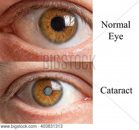 Comparison Of A Healthy Human Eye And An Eye With A Clouded Lens Cataract.