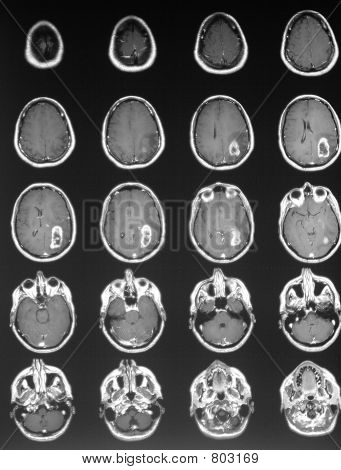 agydaganat mri