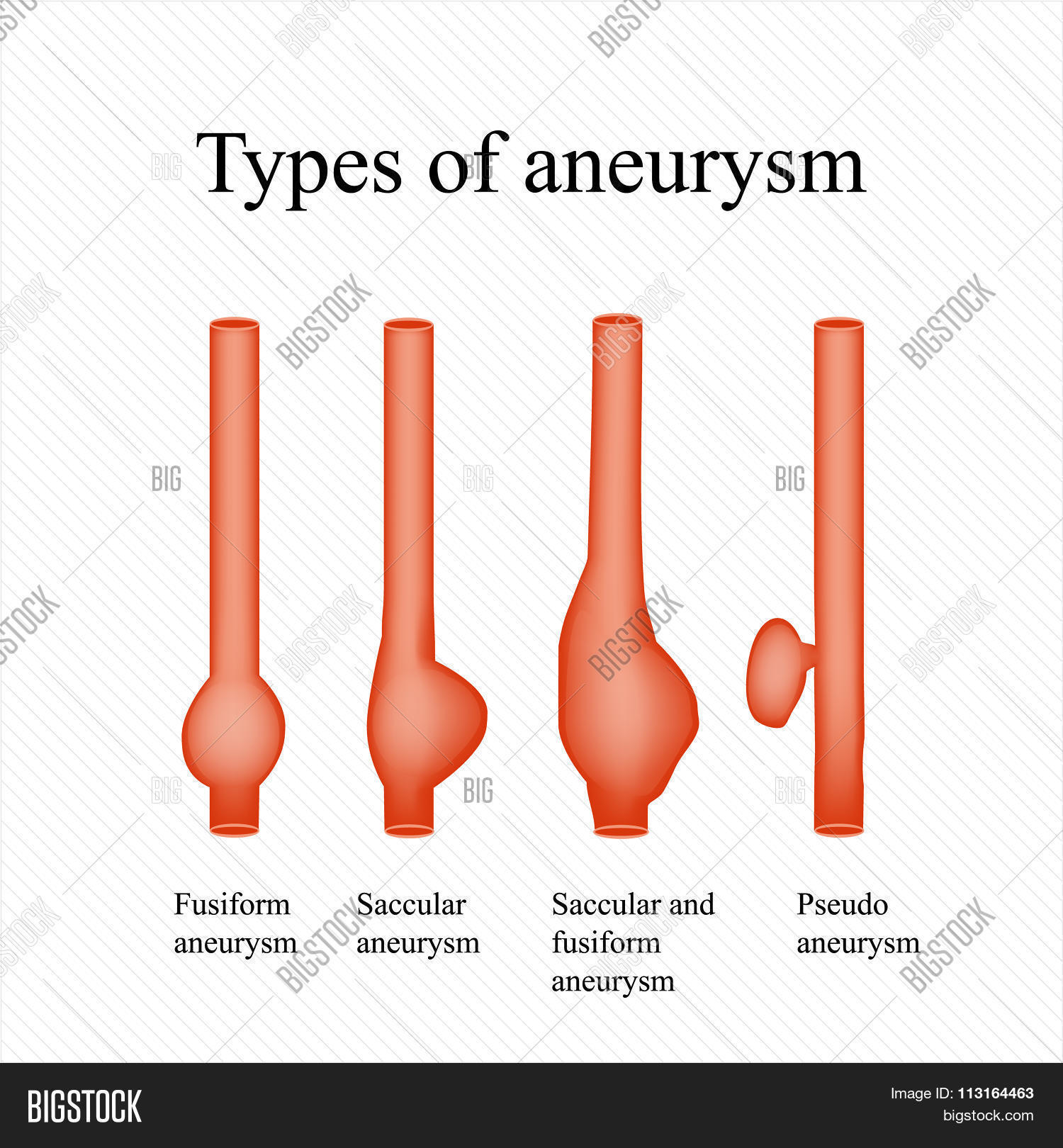 Aneurysm. Types Vector & Photo (Free Trial) Bigstock