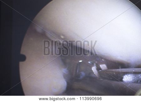 Hospital Surgery Arthroscopy Operation Screen