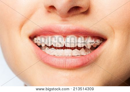 Close-up picture of healthy smile woman with clear brackets