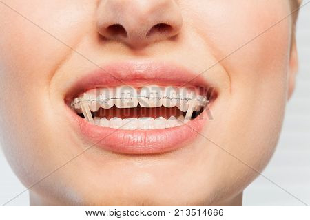 Close-up picture of female mouth with orthodontic elastic bands on braces