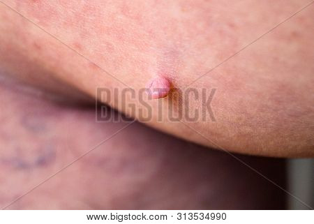 Mole On The Foot, Removal Of Moles Or Warts