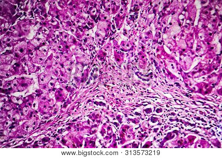 Histopathology Of Biliary Liver Cirrhosis, Light Micrograph, Photo Under Microscope