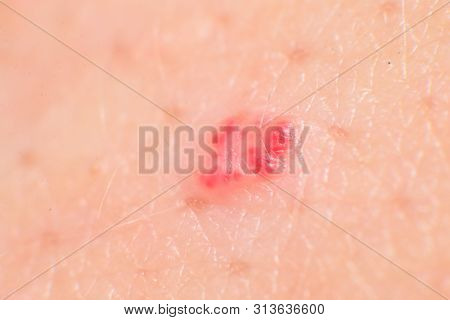 Cherry Angiomas On Male Skin - Super Macro Close Up