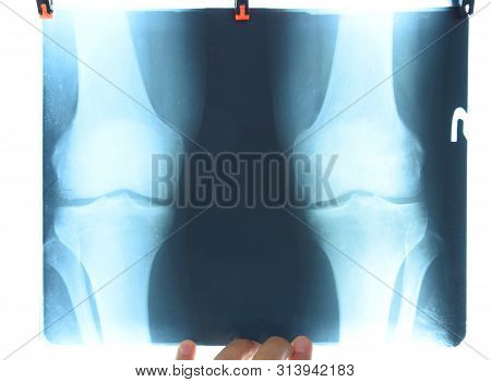 X-ray Of The Knee Joints, A Picture Of The Bones Of The Knee On The X-ray.