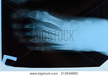 X-ray Of Toes. Foot On X-ray. Bone Research