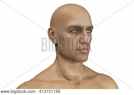 Thyroid Cancer In Men, 3d Illustration Showing Neck Nodule