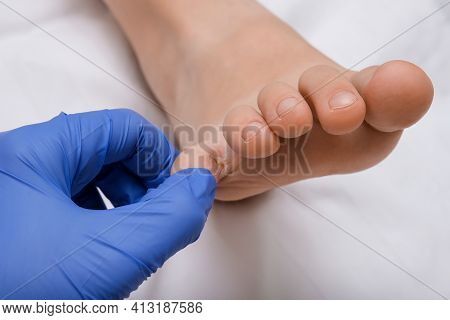 A Doctor Examines A Foot With Dyshydrotic Eczema, Atopic Dermatitis Injury, Damage On Foot And Toes 