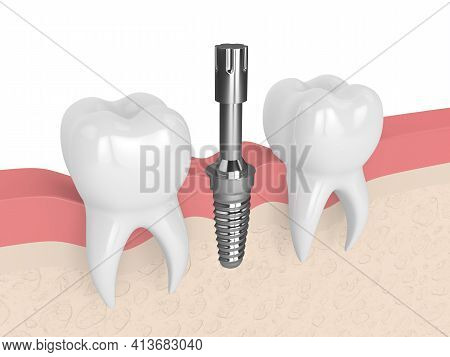 3d Render Of Dental Implant With Multipeg To Check Implant Stability