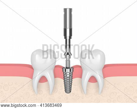 3d Render Of Dental Implant With Multipeg To Check Implant Stability
