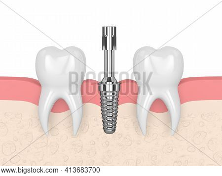 3d Render Of Dental Implant With Multipeg To Check Implant Stability