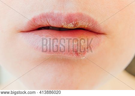 Close Up Of Girl Lips Affected By Herpes. Treatment Of Herpes Infection And Virus. Part Of Young Wom