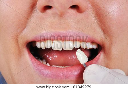 Shade Determination Tooth