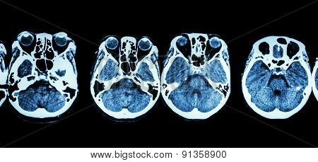 Ct Scan Of Brain And Base Of Skull