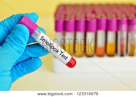 Test tube with blood sample for smallpox test