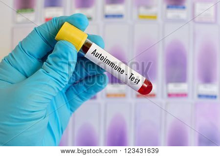 Test tube with blood sample for autoimmune disease test