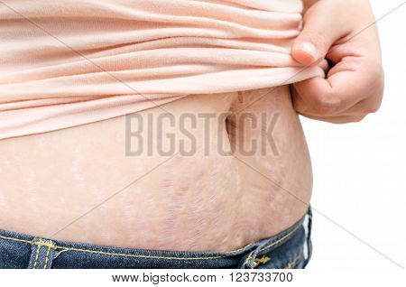 Asian woman showing stretchmarks on her skin over white