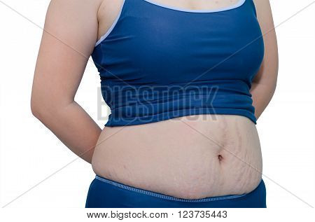 Woman in swim suit showing her stretch mark