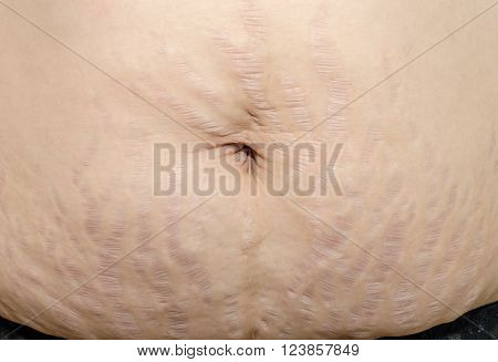 Closeup stretch marks at asian woman belly