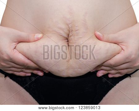 Closeup stretch marks at asian woman belly